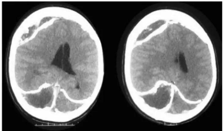 Figure 2. Brain MRI demonstrating the extent of bilateral  calciied SDHs encasing the brain giving appearance of an  armored brain
