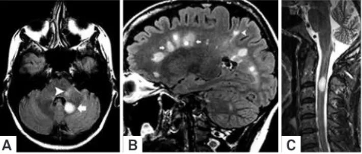 Figure 1. Spatial distribution patterns of lesions included in  the current criteria for MS