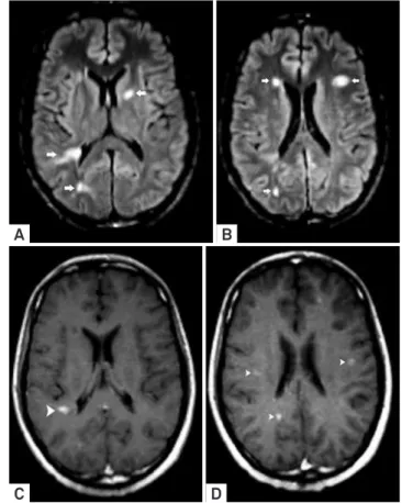 Figure 2. Neuroborreliosis manifesting with disseminated  white matter lesions in the brain and spinal cord