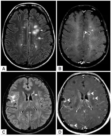 Figure 4. Neurocysticercosis mimicking “open-ring” Gd  enhancement. MS typical supratentorial lesions (arrows)  hyperintense on FLAIR images (A) and “open-ring” 