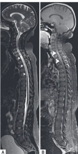Figure 10. Cytomegalovirus acute myelitis. Sagittal T2  WI (A) and comparative T1 WI post-Gd administration (B)  demonstrated central hyperintensity with minimal expansion  of long-segment cervico-thoracic lesion in the spinal cord with  heterogeneous cont