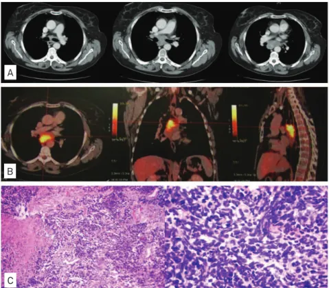 Fig 1. (A) Thoracic computed tomography showed posterior mediastinal mass. (B) [(18)F]fluoro-2-deoxy-D-glucose positron  emission tomography/computed tomography imaging revealed area of abnormal FDG accumulation in posterior mediastinal  topography
