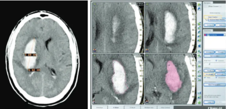 Fig 1. (A) Axial computed tomography scan slice displaying the method of linear measurement using DicomWorks software;  