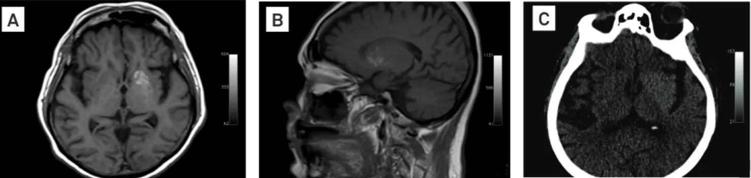 Fig 1. T1-weighted brain MRI showed classic image of hyperglycemia-induced lesion; there was no hyperglycemia but there were  choreic movements (A, axial; B, sagittal)