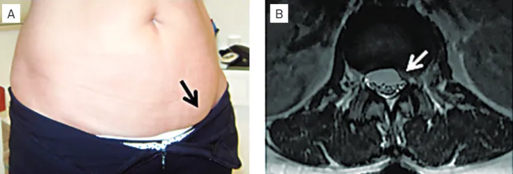 Fig 1. (A) Bulging of the left lower part of the abdomen while standing upright. (B) Axial T2-weighted MRI sequence showing a L1- L1-L2 disk herniation and left side displacement of the dura mater at the L1 level.