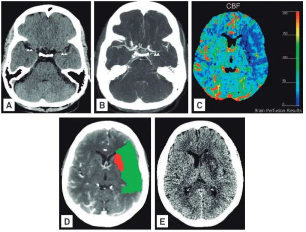 Fig 2. Intra-luminal thrombus undetected on the noncontrast computed tomography obtained one hour after the onset of  ischemic symptoms in a 68-year-old woman