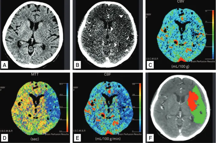 Fig 3. Multiparametric multidetector computed tomography on hyperacute ischemic stroke obtained four hours after the onset  of ischemic symptoms in a 68-year-old woman