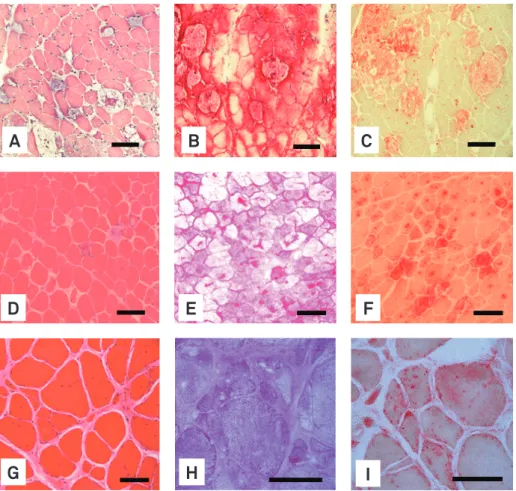 Fig 4. Pompe disease (adult form). Variations in iber diameter, vacuolated ibers illed with glycogen, increase activity of acid phosphatase  (focal, diffuse and positive ibers) and splitting ibers