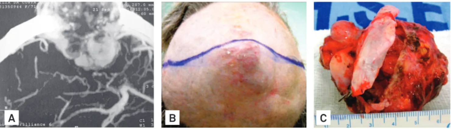 Fig 2. This patient, a 59-year old woman, noticed a tender lump on the top of her head