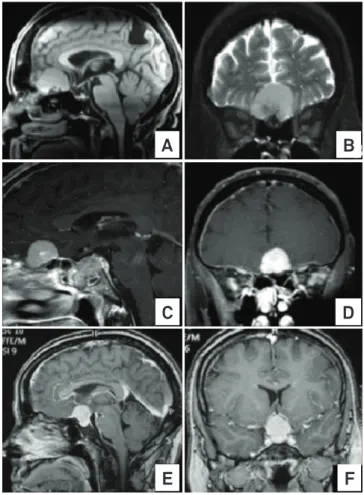 Fig 1. (A and B) Case 1 Magnetic Resonance Imaging (MRI)  T1 without contrast showing lesion on olfactory groove  and encephalomalacia area in parietal region secondary  to a previous ischemic insult