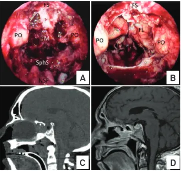 Fig 2. (A) Exposure of the anterior skull base meningioma  (M), limited anteriorly by the frontal sinus (FS), laterally  by the periorbits (PO) and posteriorly by the sphenoidal  sinus (SphS)