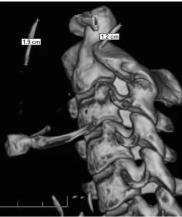 Fig 2. CT scan image showing increased styloid processes: 