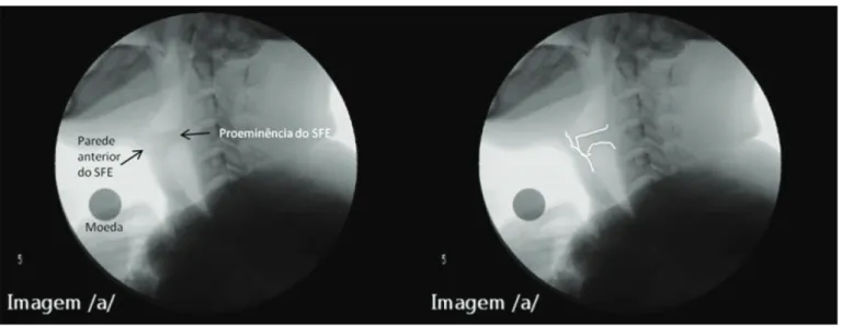 Figura 2.  Imagens videofluoroscópicas com exemplo de grau de contato moderado da proeminência do segmento faringoesofágico com a parede  anterior