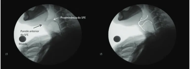 Figura 3.  Imagens videofluoroscópicas com exemplo de grau de contato intenso da proeminência do segmento faringoesofágico (SFE) com a  parede anterior