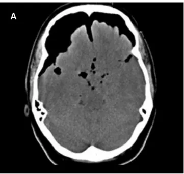 Fig 1. Computed tomography shows huge pneumocephalus  extending from right temporal fossa and bilateral frontal region  until convexity compressing supratentorial ventricular system.