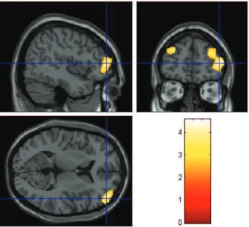 Fig 2. Findings of extralimbic brain structural abnormalities in  patients with major depression.