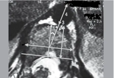 Figura 2.  RNM demonstrando ângulo c-a e distância aorta-canal aumentados,  com póstero-lateralização da aorta em paciente com EIA.