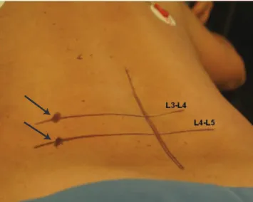 Fig 1. Entry point to L4-L5 space with the needle insertion at a  45º to the posterior horizontal plane, directing it to the center  of the intervertebral disc.
