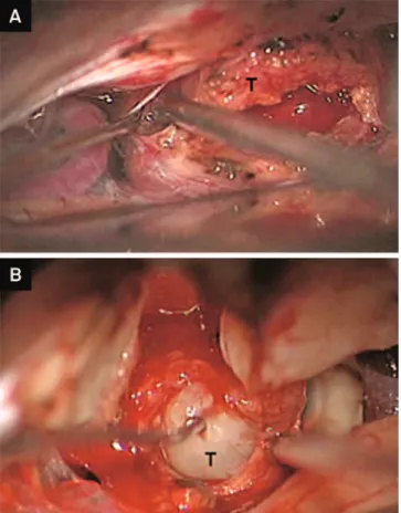 Figure 1. (A) The dissection begins near the porus, where the arachnoid is thicker and the dissection plane between tumor (T) and the arachnoid membrane is easier found; (B) The tumor capsule remains opaque and devascularized due to the displacement of the