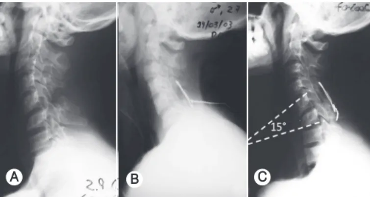 Figura 3.  Exemplo de cifose segmentar. (A) Pré-operatório. (B) Pós-opera- Pós-opera-tório imediato com recuperação da lordose cervical