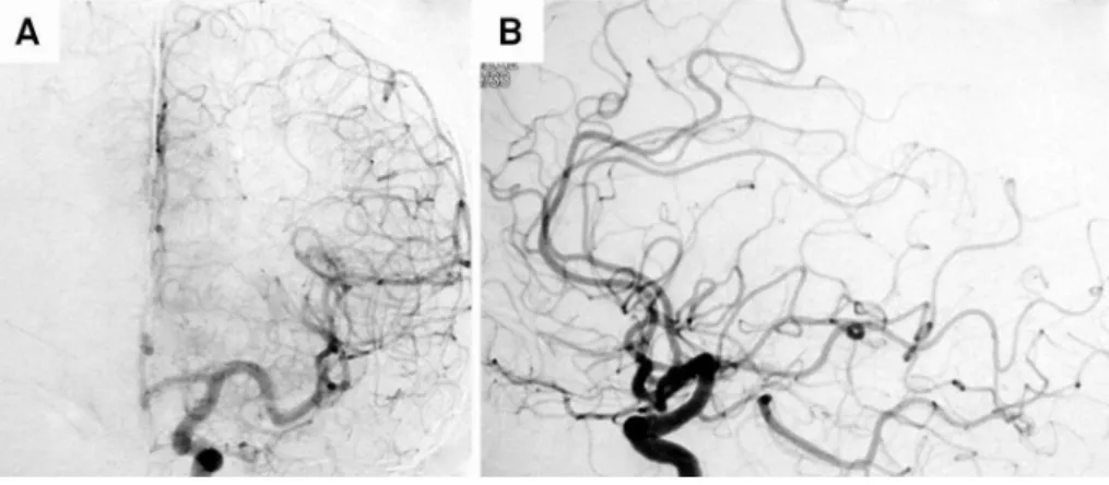 Figure 3. Left internal carotid artery angiogram revealed complete spontaneous regression of the AVM.