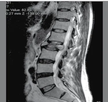Figura 2.  Imagem sagital de Ressonância Nuclear Magnética T2, mostrando  lesão tumoral do corpo vertebral e compressão do saco dural.