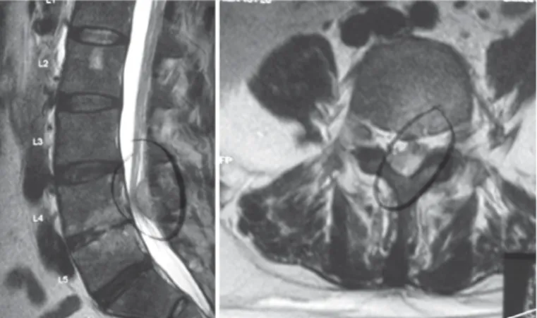 Figura 6.  RNM: ausência abscesso epidural nível L4-L5. DISCUSSÃO