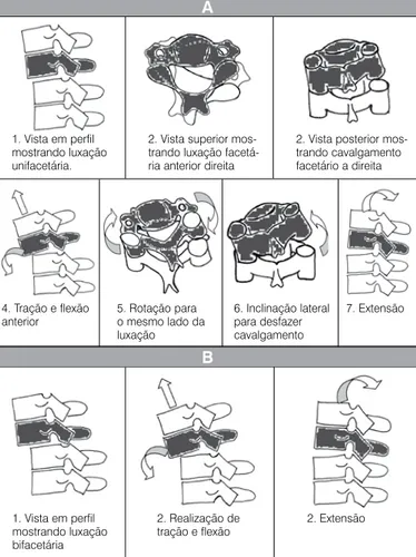 Figura 1.  Manobras de redução das luxações cervicais: (A) unifacetária e  (B) bifacetária.