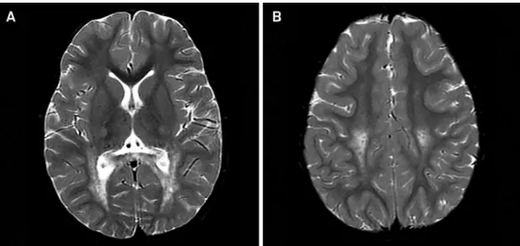 Figure 5. Adult-onset Alexander disease in a 47-year-old female. Axial FLAIR images shows atrophy of the medulla with hyperintensity in the projection of corticospinal tracts (arrow in A), bilateral hyperintensity in the deep cerebellar white matter (B) an