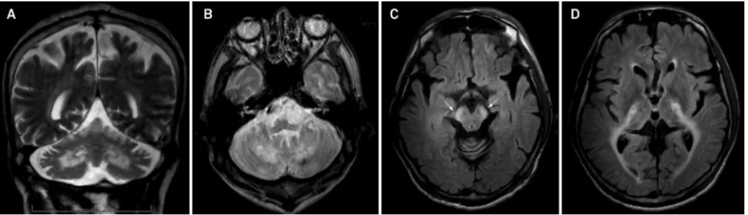 Figure 9. Nasu-Hakola disease in a 46-year-old man. Unenhanced CT (A) shows punctuate calcifications in the lentiform nuclei.