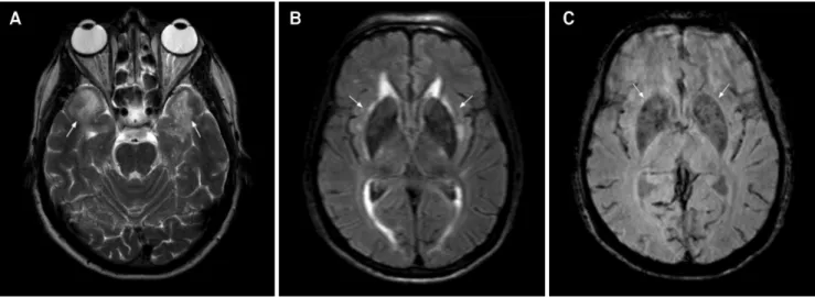 Figure 10. CADASIL in a 54-year-old male. Axial T2-weighted image (A) shows white matter hyperintense lesions in the temporal poles (arrows)