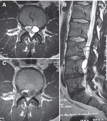 Figura 2-  Imagens de ressonância nuclear magnética do paciente. A, B,  imagens pesadas em T2