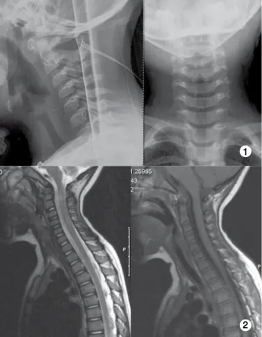 Tabela 1. Resumo dos doentes com diagnóstico de SCIWORA.