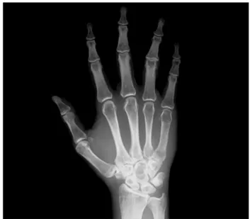 Figure 1. R-xays of the right hand demonstrates multiple cystic lesions in the carpal bones.