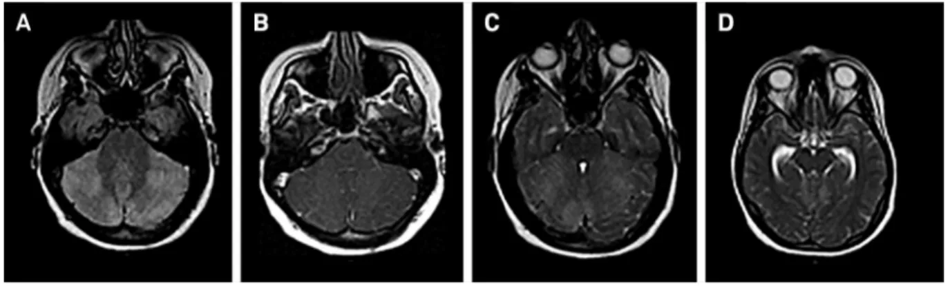 Figure 1. Axial FLAIR (A) and corresponding post contrast T1 image (B) show areas of high signal in both gray and white matter without enhancement