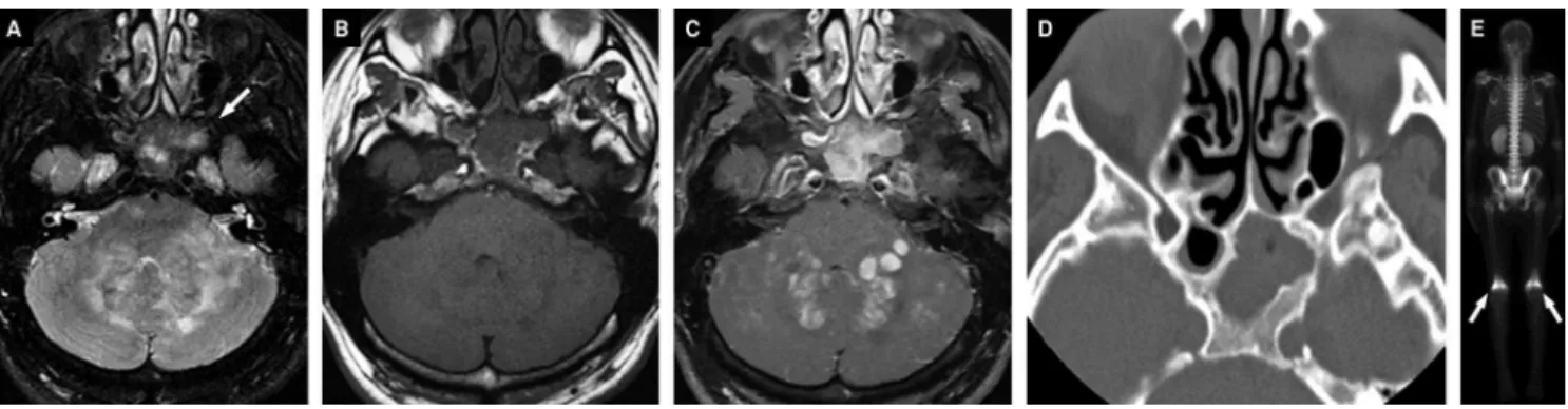 Figure 8. A 35-year-old male patient diagnosed with Erdheim-Chester disease. Axial T2WI shows bilateral hyperintensity in the cerebellar white matter, middle cerebellar peduncles and pons, as well as low signal intensity filling the sphenoid sinus (A and a