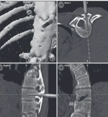 Figura 3. Principais níveis da deformidade vertebral que estavam distorcidos,  inviabilizando parâmetros anatômicos.