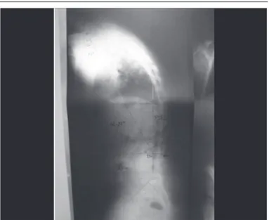 Figura 1. Radiografia do pré-operatório do paciente com desequilíbrio sagital  após artrodese posterior com haste de Harrington.