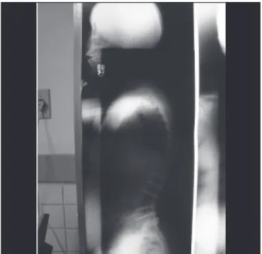 Figura 5. Radiografia em perfil com evidência do fechamento da cunha  formada pela osteotomia no corpo vertebral de L3.