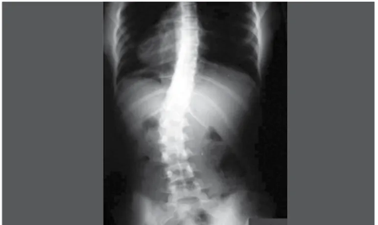 Figura 1. Exemplo de imagem radiográfica ântero-posterior utilizada para  mensuração angular de coluna escoliótica.