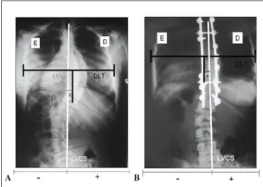 Figura 1. As radiografia de um paciente com escoliose idiopática do ado- ado-lescente e a analise do trunk shift pré e pós-operatória com uso de  parafu-sos pediculares
