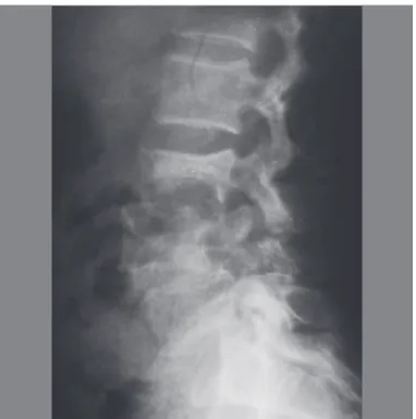 Figura 8.  Aspecto intraoperatórios de abscesso por espondilodiscite –  incisão da via de acesso.