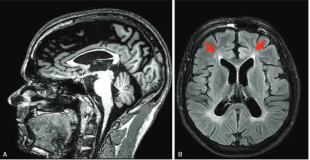 Figure 2. Magnetic resonance imaging of the brain of a patient with mutation in the PLP1 gene (SPG2 phenotype)