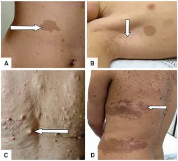 Figure 2. Cutaneous lesions (arrows): Multiple cafe au lait lesions (CAL) (A); freckling and two CAL (B); Discrete  neurofi-bromas (C); Pigmented skin lesions (epidermal nevus)  mis-diagnosed as CAL and freckling in a non-NF1 patient (D).