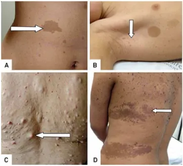 Figure 2. Cutaneous lesions (arrows): Multiple cafe au lait lesions (CAL) (A); freckling and two CAL (B); Discrete  neurofi-bromas (C); Pigmented skin lesions (epidermal nevus)  mis-diagnosed as CAL and freckling in a non-NF1 patient (D).