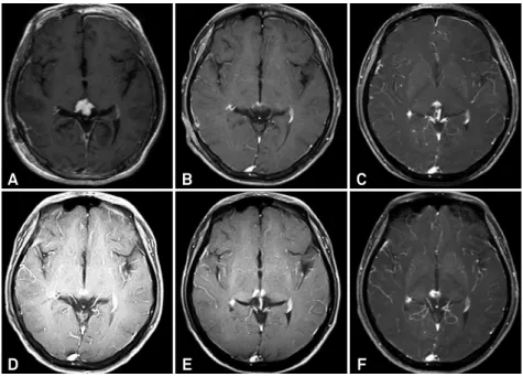 Figure 4. Follow-up MRIs of an 18-year-old male patient treated with GKS only. An enhanced lesion (A) was found in the pineal  region and decreased 3 months after GKS (B)
