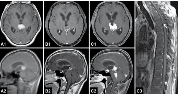 Figure 5. Follow-up MRIs of a 45-year-old male patient treated with GKS, Chemo, and WBSRT