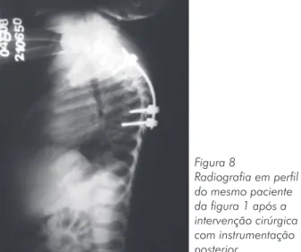 Figura 8 Radiografia em perfil  do mesmo paciente  da figura 1 após a  intervenção cirúrgica  com instrumentação  posterior.