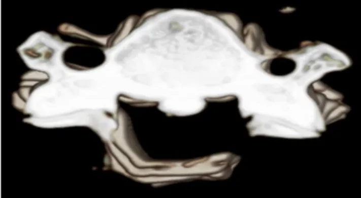 Figure 2. Three-dimensional CT scan showing a greenstick  fracture (right) after the opening of the lamina on the left side.