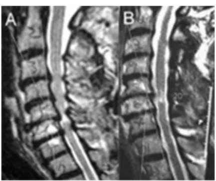 Figure 3. Sagittal IRM showing preoperative (A) and  postoperative (B) status.
